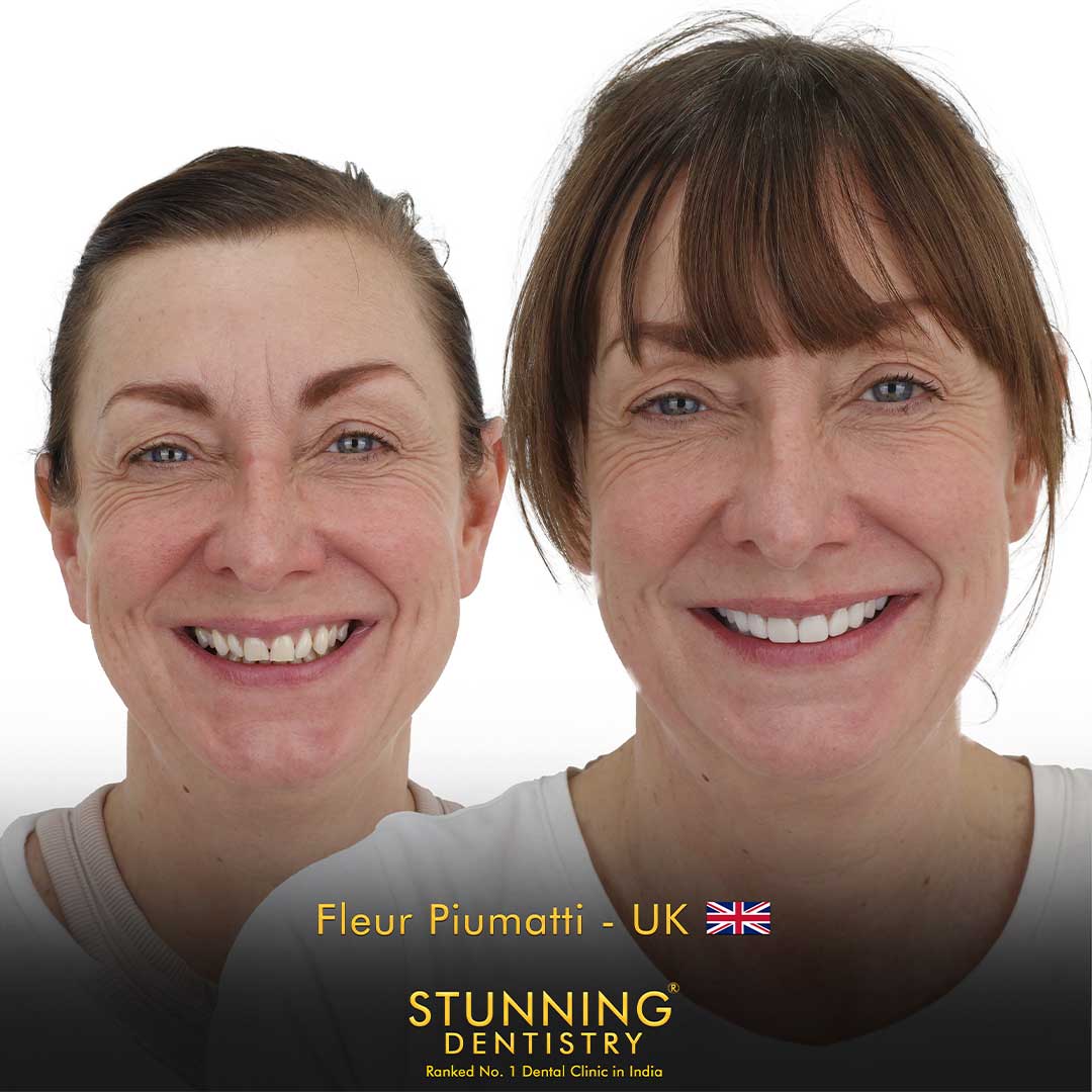 Dental Implants - photo 1